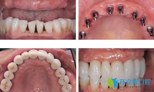 沈陽歡樂口腔李金剛怎么樣？李主任半口種植牙著真人案例來證明