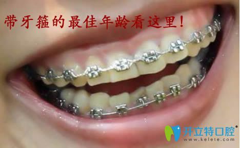 資深牙醫(yī)生告訴你帶牙箍的年齡