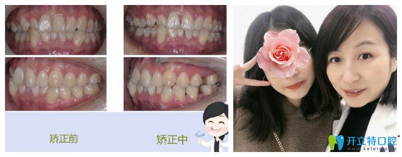 福州維樂口腔郭淑蘋牙齒矯正案例