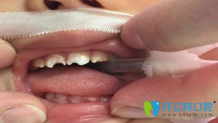 孩子補牙全麻會影響智力嗎