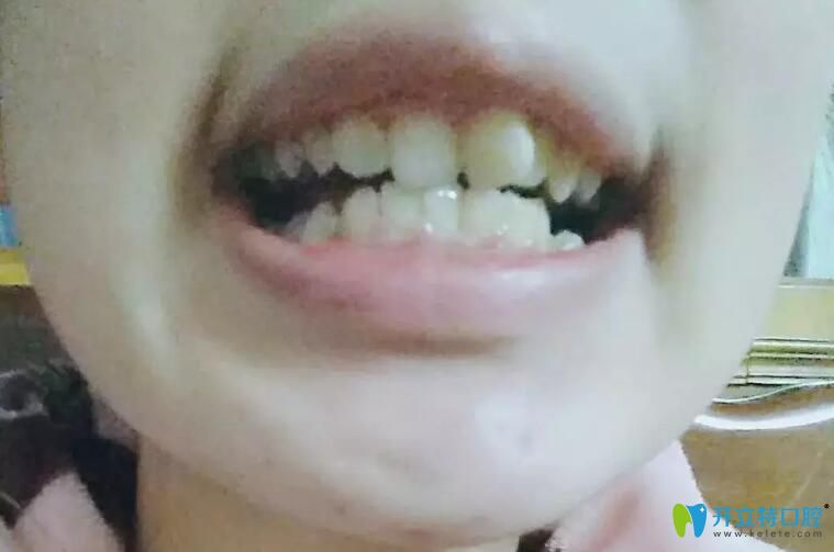 僅花1年時(shí)間在上海英博口腔矯正骨性深覆合