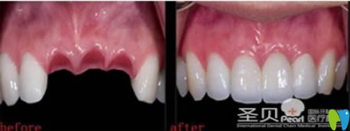 成都圣貝30歲顧客門(mén)牙缺失種植前后對(duì)比效果 成都圣貝30歲顧客門(mén)牙缺失種植前后對(duì)比效果