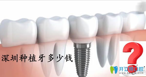 公布深圳種植牙價(jià)格表及當(dāng)?shù)卣?guī)的十大種植牙醫(yī)院排名