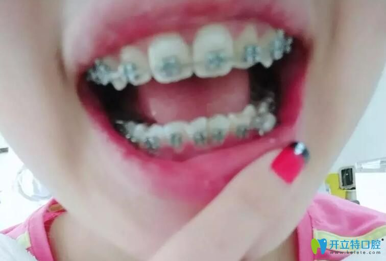 英博口腔牙齒矯正4個月照片