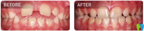 MRC矯正前后效果圖