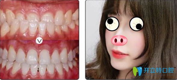 廣州圣貝成人地包天矯正前后對比照片