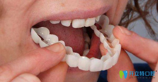 牙齒美容冠矯正需要多久