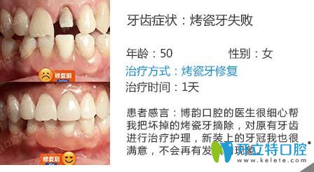 博韻口腔全科醫(yī)生丁冬梅烤瓷牙修復(fù)案例
