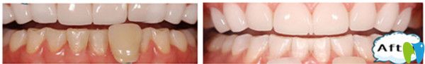 牙齒美容修復變化圖