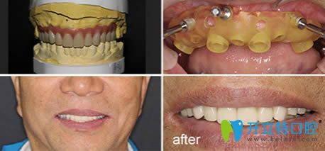 60歲的張先生做完全口種植牙后的效果