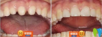 何靜醫(yī)生美容冠修復(fù)前后對(duì)比效果