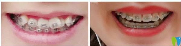 吉林愛齒口腔牙齒矯正前后對比圖