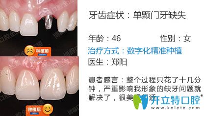 南京博韻口腔鄭陽(yáng)單顆種植效果