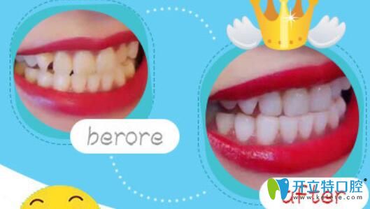 南京博韻口腔丁冬梅怎么樣？案例驗(yàn)證實(shí)力