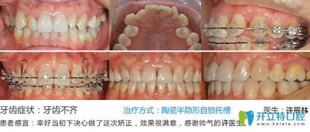 南京博韻口腔牙齒矯正案例