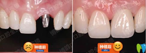 南京博韻何靜單顆牙缺失種植牙對(duì)比效果