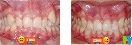南京博韻口腔青少年虎牙+深覆合矯正前后對(duì)比效果