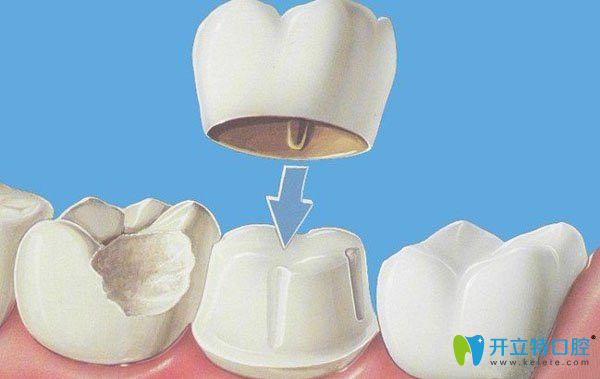 牙齒美容冠矯正技術(shù)