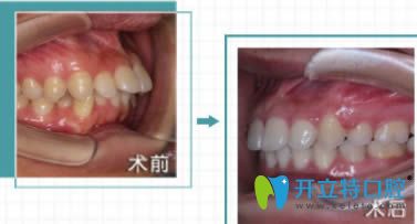 福州維樂口腔許長記醫(yī)生成人齙牙矯正前后對(duì)比照