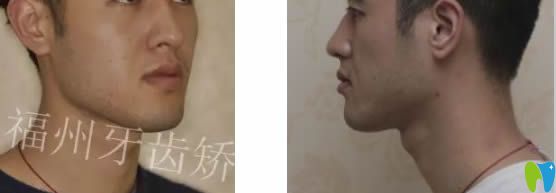 福州維樂口腔郭淑蘋醫(yī)生成人上下前牙反頜矯正臉型對(duì)比效果