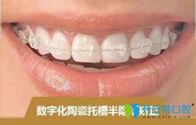 陶瓷半隱形牙套圖片