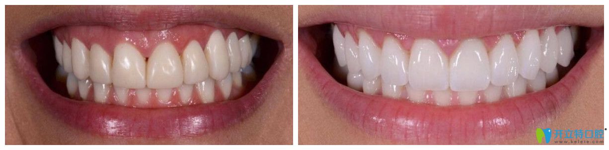 成都極光口腔全瓷美白矯正牙貼面案例
