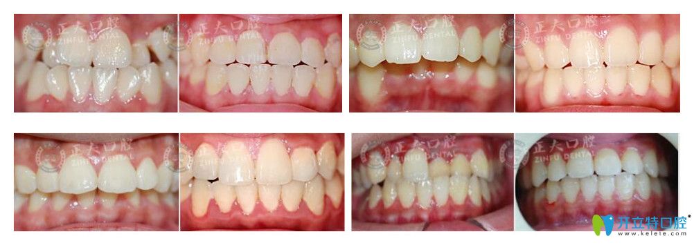 深圳正夫口腔徐國(guó)強(qiáng)lh魔法絲矯正案例效果對(duì)比圖