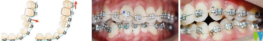 lh魔線矯正有什么優(yōu)勢(shì)