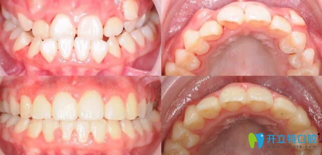 極光口腔美式兒童頜面管理，面型干預(yù)效果前后對(duì)比