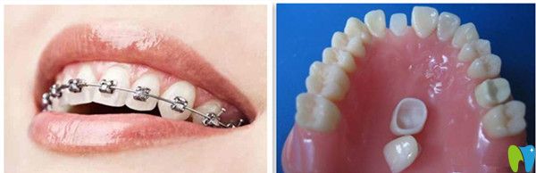 美容冠矯正與牙套矯正的區(qū)別