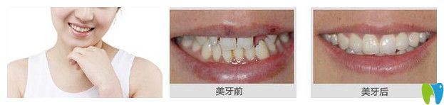 深圳正夫口腔張運(yùn)發(fā)怎么樣？真人牙齒種植修復(fù)案例效果來驗(yàn)證