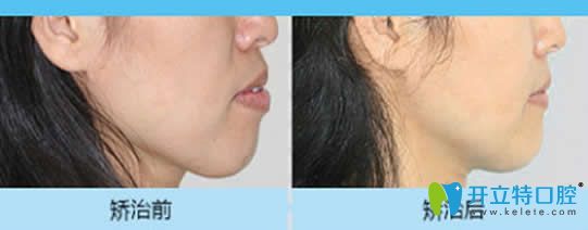 中山好民生口腔反頜矯正案例
