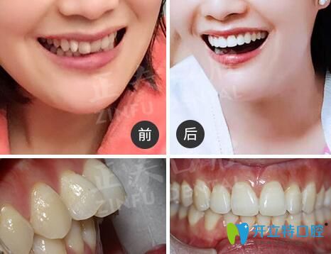 深圳正夫口腔正畸怎么樣？看多組正夫口腔牙齒矯正評價