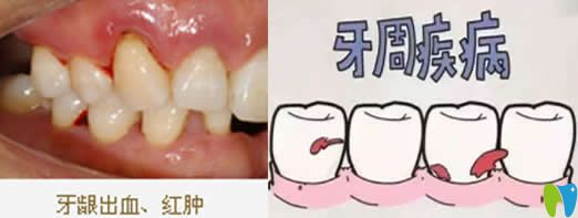 牙齦出血吃什么藥