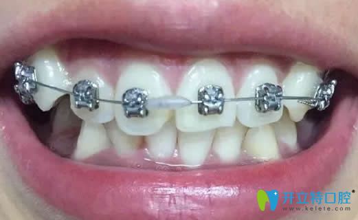 我在昆明王巍口腔做金屬矯正戴牙套第3個(gè)月
