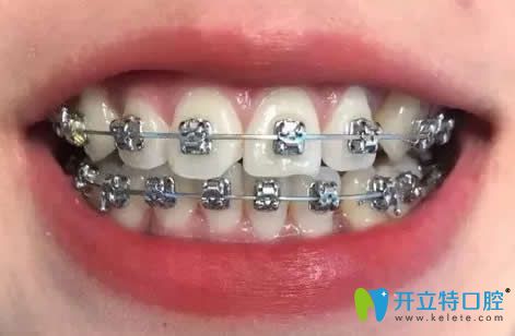 我在昆明王巍口腔做牙齒矯正15個(gè)月