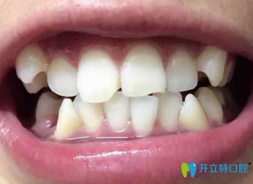 在昆明王巍口腔做金屬牙齒矯正戴牙套16個(gè)月效果分享