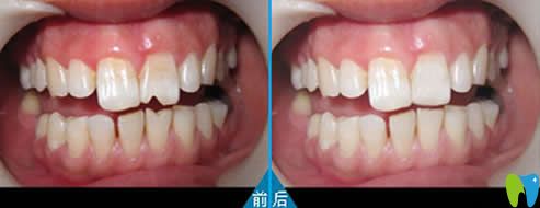 門牙磨損貼面修復(fù)效果 門牙磨損貼面修復(fù)效果