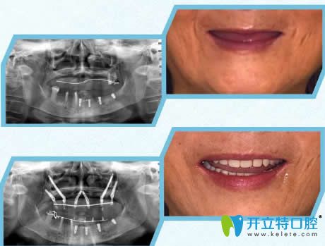 博韻口腔穿翼板+穿顴骨種植修復(fù)案例