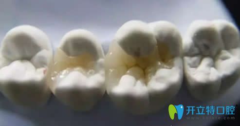 后牙磨損修復(fù)方法 后牙磨損修復(fù)方法