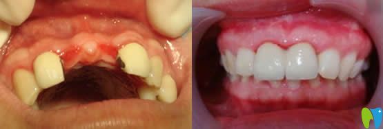 南昌安植雅口腔高敏瑗醫(yī)生門牙種植牙案例 南昌安植雅口腔高敏瑗醫(yī)生門牙種植牙案例