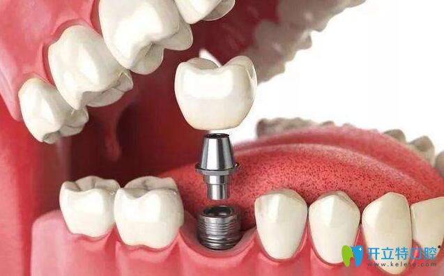 牙齒缺失不僅能做烤瓷牙、全瓷牙等等，還可以做種植牙