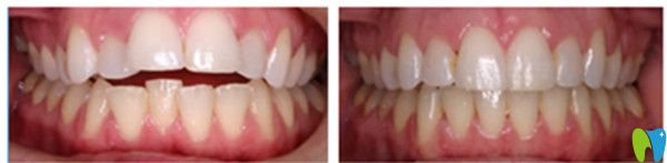 牙齒矯正對比效果圖