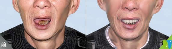 南昌安植雅口腔廖偉民全口種植牙案例 南昌安植雅口腔廖偉民全口種植牙案例