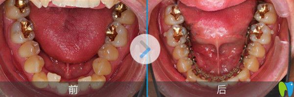 舌側(cè)隱形矯正前后效果圖 舌側(cè)隱形矯正前后效果圖