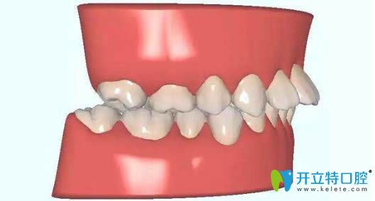 正畸醫(yī)生分享前牙深覆蓋矯正的價格需要多少錢？