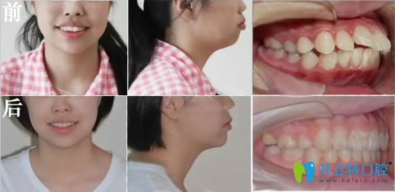 成人前牙深覆蓋矯正臉型變化對(duì)比照