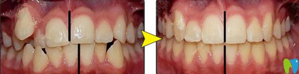 金屬托槽矯正前后對(duì)比圖 金屬托槽矯正前后對(duì)比圖