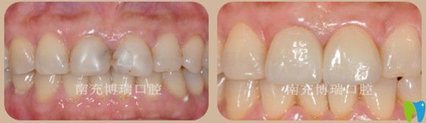 瓷貼面修復前后對比圖