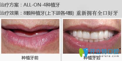 南昌安植雅口腔潘建廷醫(yī)生全口種植牙案例 南昌安植雅口腔潘建廷醫(yī)生全口種植牙案例